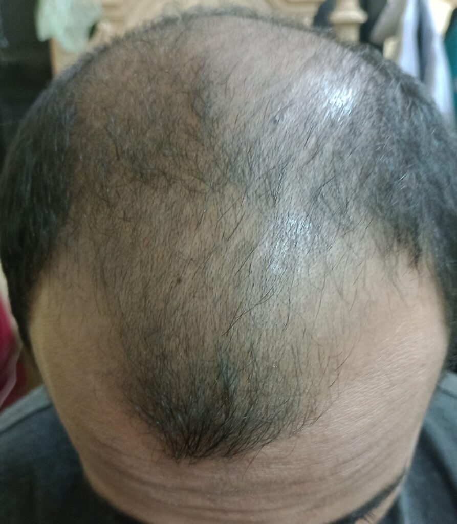 young age hair loss